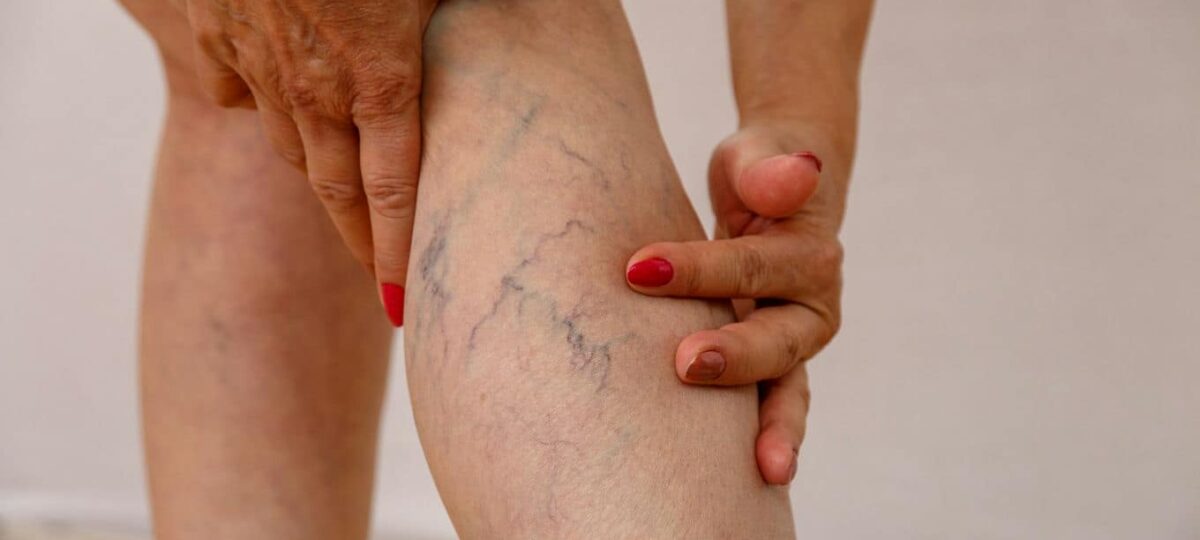 żylaki na nogach